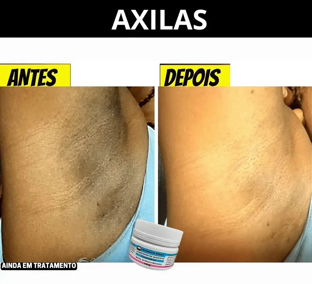 Antes depois axilas