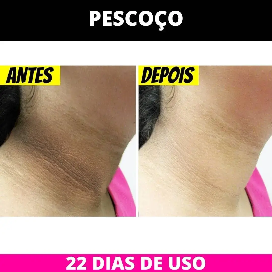 Antes depois pescoço